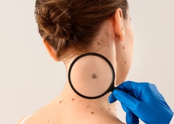 Câncer de pele: Semsa reforça prevenção e alerta para sinais iniciais