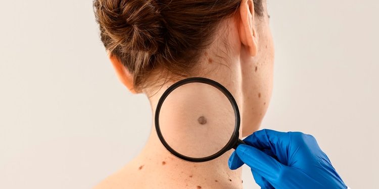 Câncer de pele: Semsa reforça prevenção e alerta para sinais iniciais